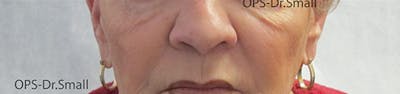 Fillers Before & After Gallery - Patient 666369 - Image 1