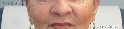 Fillers Before & After Gallery - Patient 666369 - Image 2