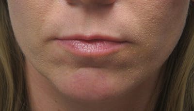 Fillers Before & After Gallery - Patient 146867 - Image 1
