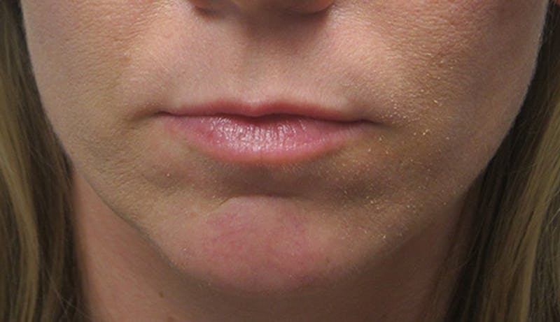 Fillers Before & After Gallery - Patient 146867 - Image 1