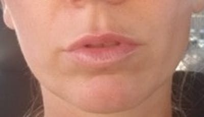 Fillers Before & After Gallery - Patient 146867 - Image 2
