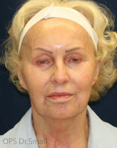 Cheek Lift Before & After Gallery - Patient 389375 - Image 1