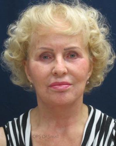 Cheek Lift Before & After Gallery - Patient 389375 - Image 2