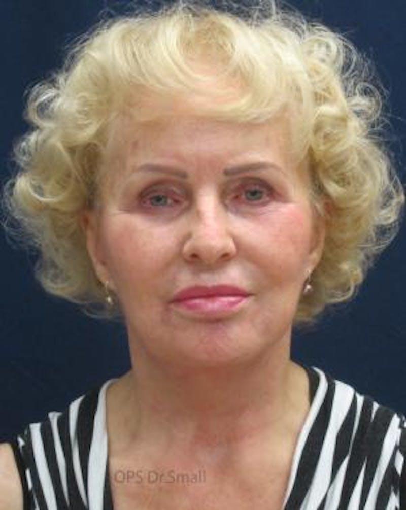 Cheek Lift Before & After Gallery - Patient 389375 - Image 2