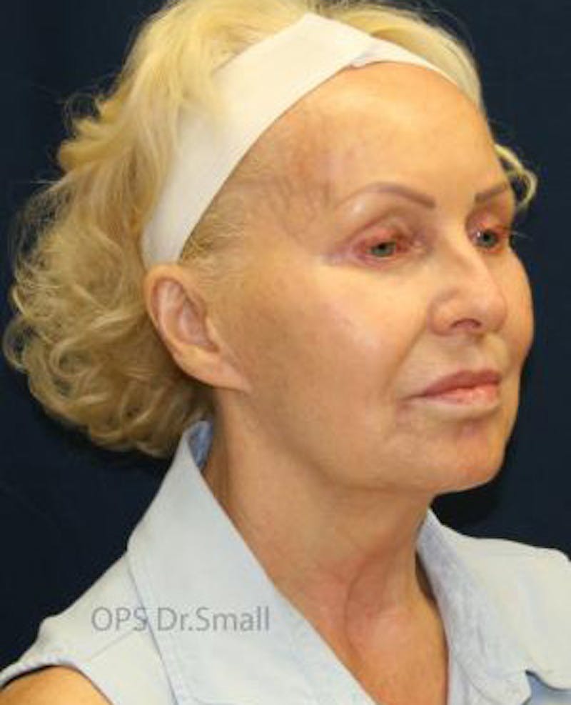 Cheek Lift Before & After Gallery - Patient 389375 - Image 3