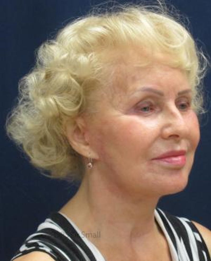 Cheek Lift Before & After Gallery - Patient 389375 - Image 4