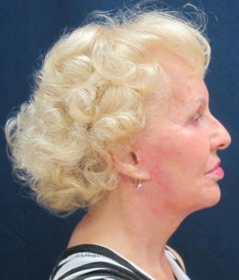 Cheek Lift Before & After Gallery - Patient 389375 - Image 6
