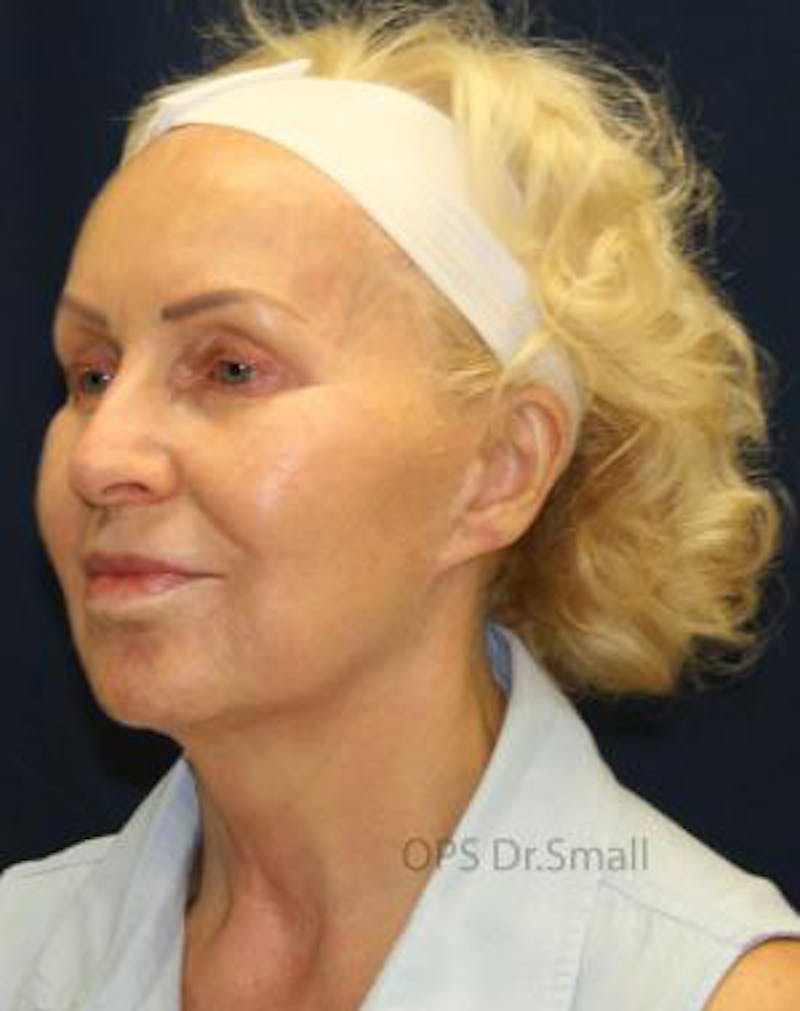 Cheek Lift Before & After Gallery - Patient 389375 - Image 7