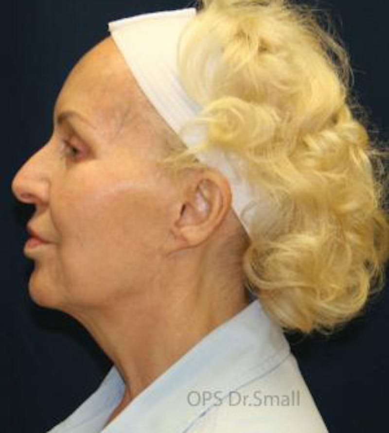 Cheek Lift Before & After Gallery - Patient 389375 - Image 9