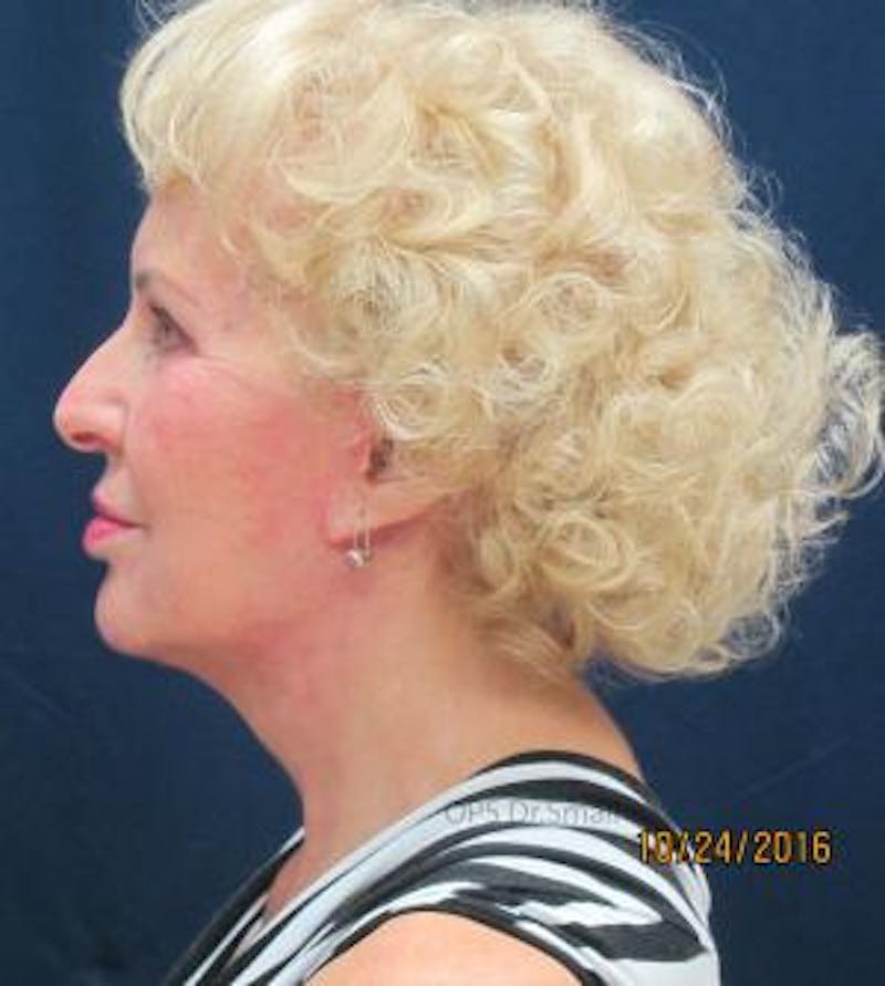 Cheek Lift Before & After Gallery - Patient 389375 - Image 10