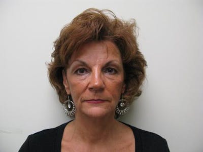 Cheek Lift Before & After Gallery - Patient 352464 - Image 1