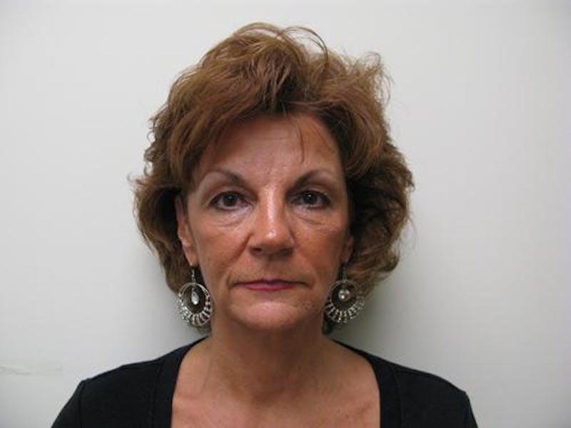 Cheek Lift Before & After Gallery - Patient 352464 - Image 1
