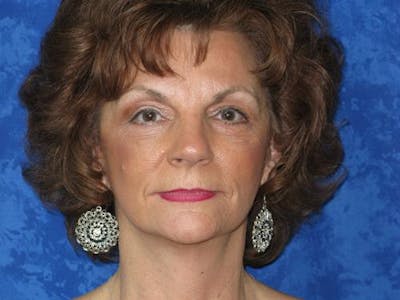 Cheek Lift Before & After Gallery - Patient 352464 - Image 2