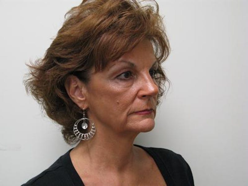 Cheek Lift Before & After Gallery - Patient 352464 - Image 3