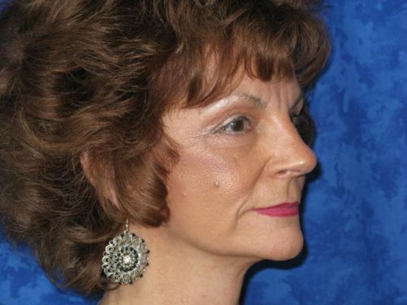 Cheek Lift Before & After Gallery - Patient 352464 - Image 4