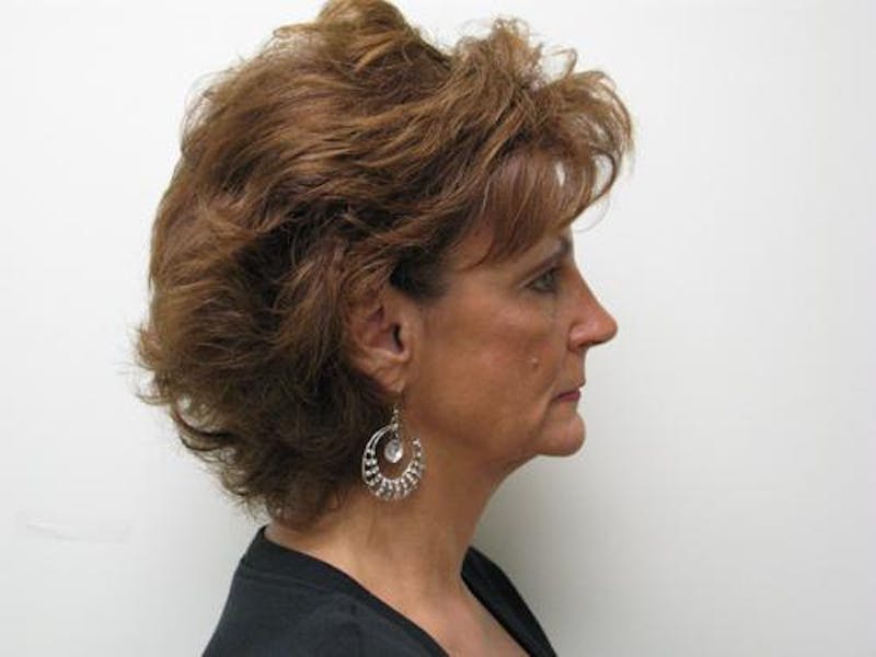 Cheek Lift Before & After Gallery - Patient 352464 - Image 5