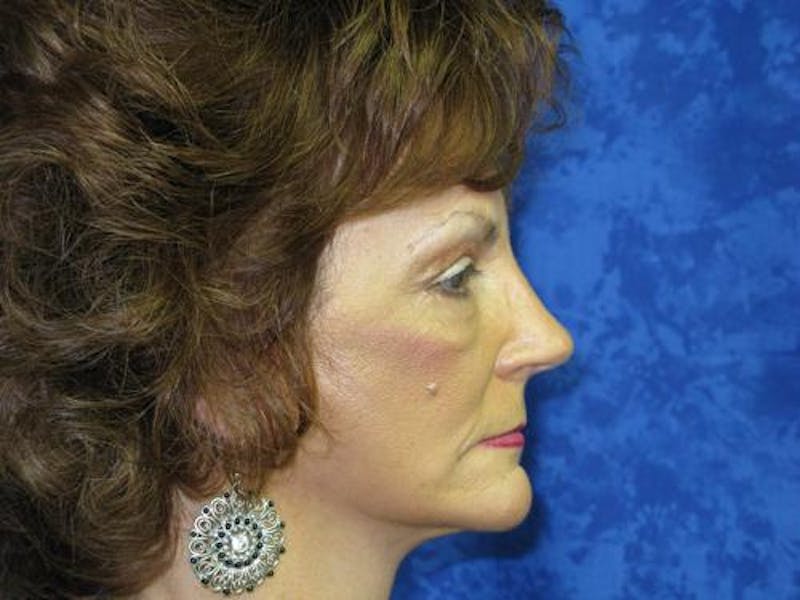 Cheek Lift Before & After Gallery - Patient 352464 - Image 6