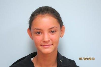 Otoplasty (Ear Tuck) Before & After Gallery - Patient 438859 - Image 1