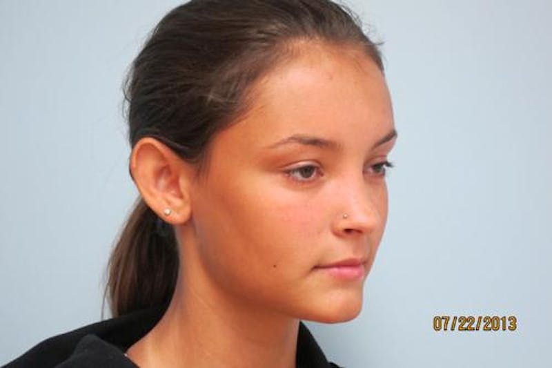 Otoplasty (Ear Tuck) Before & After Gallery - Patient 438859 - Image 3
