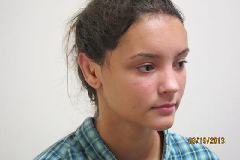 Otoplasty (Ear Tuck) Before & After Gallery - Patient 438859 - Image 4