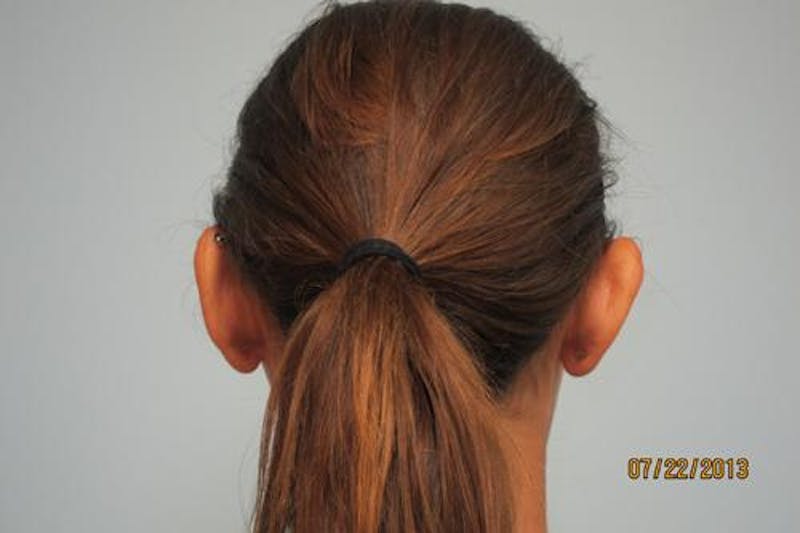 Otoplasty (Ear Tuck) Before & After Gallery - Patient 438859 - Image 5