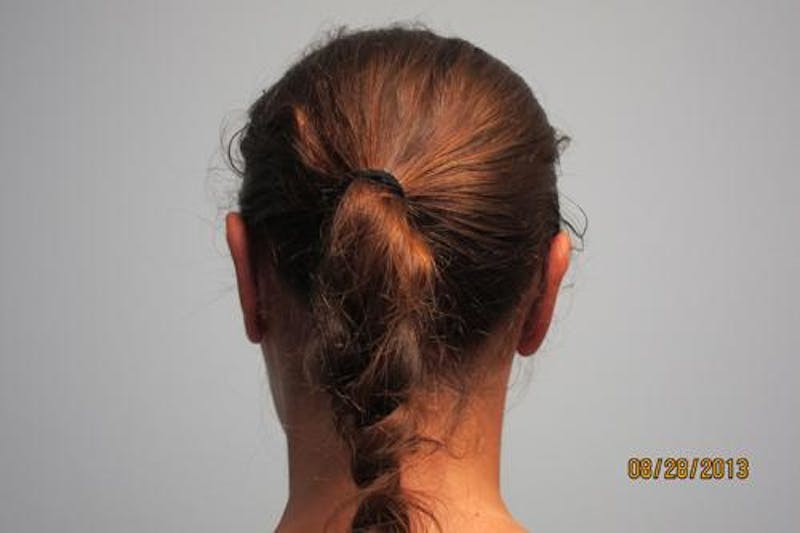 Otoplasty (Ear Tuck) Before & After Gallery - Patient 438859 - Image 6