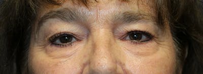 Blepharoplasty (Eyelids) Before & After Gallery - Patient 427147 - Image 1