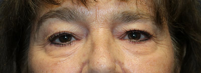 Blepharoplasty (Eyelids) Before & After Gallery - Patient 427147 - Image 1