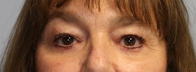 Blepharoplasty (Eyelids) Before & After Gallery - Patient 427147 - Image 2