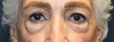 Blepharoplasty (Eyelids) Before & After Gallery - Patient 186146 - Image 1