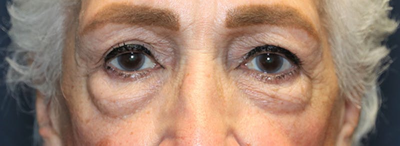 Blepharoplasty (Eyelids) Before & After Gallery - Patient 186146 - Image 1
