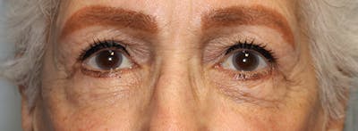 Blepharoplasty (Eyelids) Before & After Gallery - Patient 186146 - Image 2