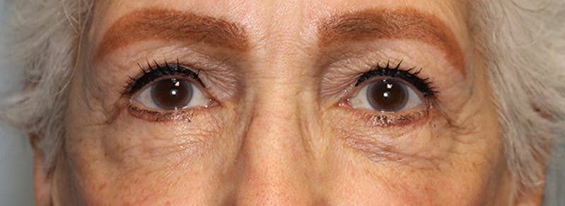 Blepharoplasty (Eyelids) Before & After Gallery - Patient 186146 - Image 2