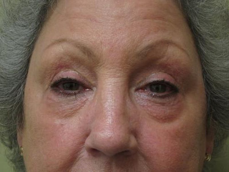 Blepharoplasty (Eyelids) Before & After Gallery - Patient 247871 - Image 1