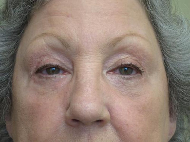 Blepharoplasty (Eyelids) Before & After Gallery - Patient 247871 - Image 2