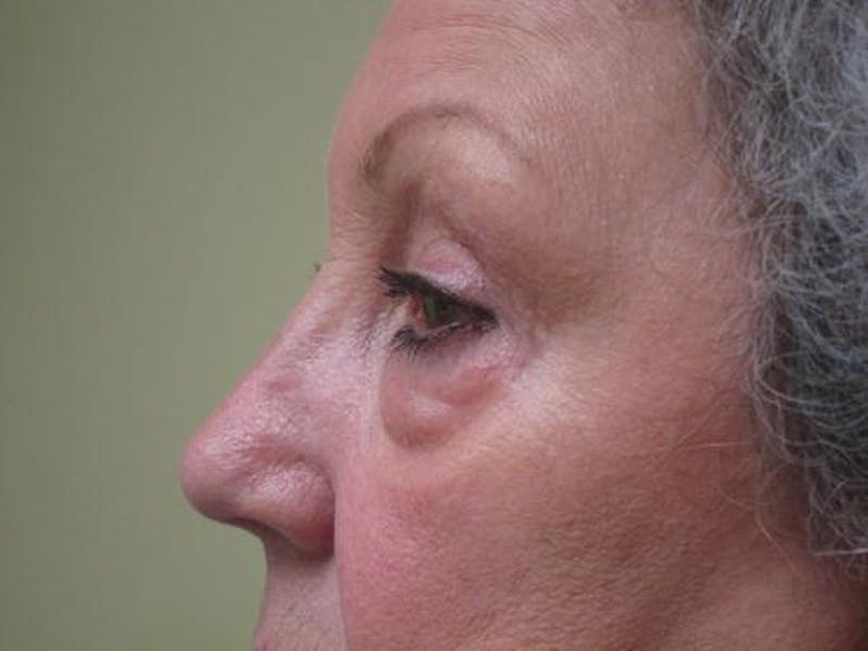 Blepharoplasty (Eyelids) Before & After Gallery - Patient 247871 - Image 3