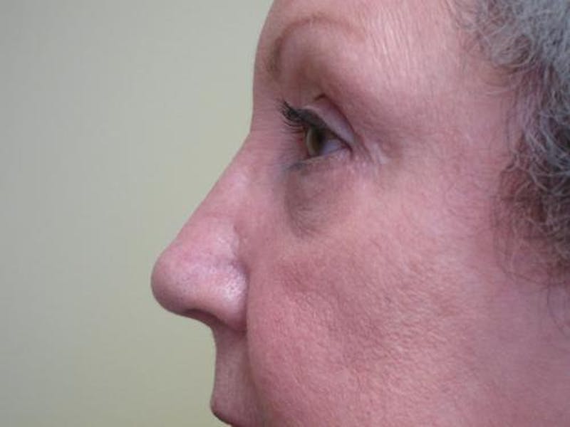 Blepharoplasty (Eyelids) Before & After Gallery - Patient 247871 - Image 4