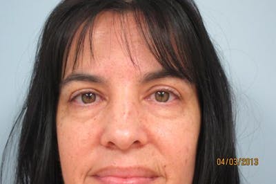 Blepharoplasty (Eyelids) Before & After Gallery - Patient 404604 - Image 1