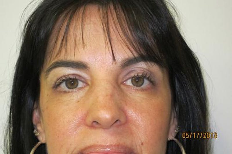 Blepharoplasty (Eyelids) Before & After Gallery - Patient 404604 - Image 2