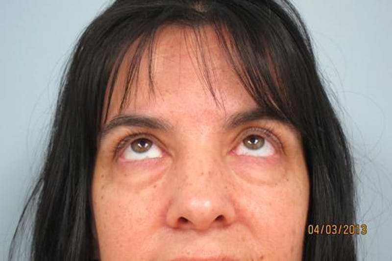 Blepharoplasty (Eyelids) Before & After Gallery - Patient 404604 - Image 3