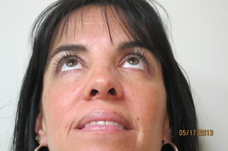 Blepharoplasty (Eyelids) Before & After Gallery - Patient 404604 - Image 4