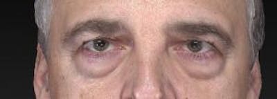 Blepharoplasty (Eyelids) Before & After Gallery - Patient 302560 - Image 1