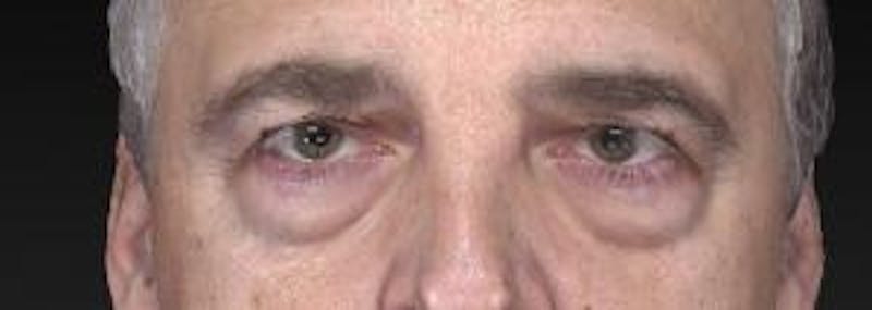 Blepharoplasty (Eyelids) Before & After Gallery - Patient 302560 - Image 1