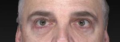 Blepharoplasty (Eyelids) Before & After Gallery - Patient 302560 - Image 2