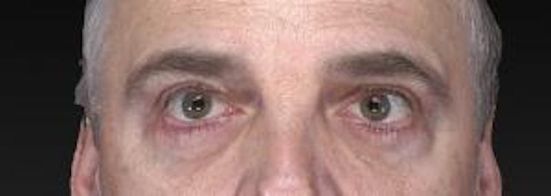 Blepharoplasty (Eyelids) Before & After Gallery - Patient 302560 - Image 2