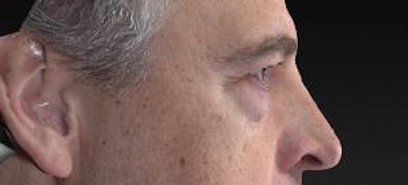 Blepharoplasty (Eyelids) Before & After Gallery - Patient 302560 - Image 3