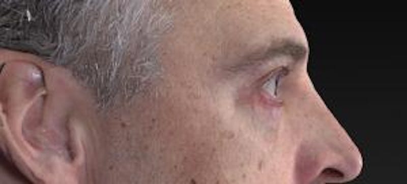 Blepharoplasty (Eyelids) Before & After Gallery - Patient 302560 - Image 4
