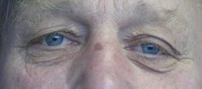 Blepharoplasty (Eyelids) Before & After Gallery - Patient 353758 - Image 1