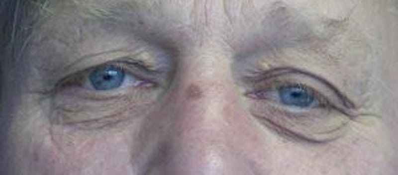 Blepharoplasty (Eyelids) Before & After Gallery - Patient 353758 - Image 1