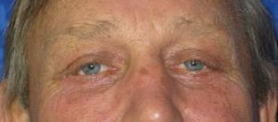 Blepharoplasty (Eyelids) Before & After Gallery - Patient 353758 - Image 2